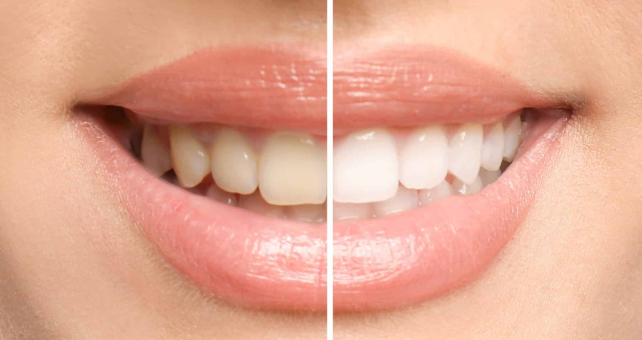 teeth whitening before and after image