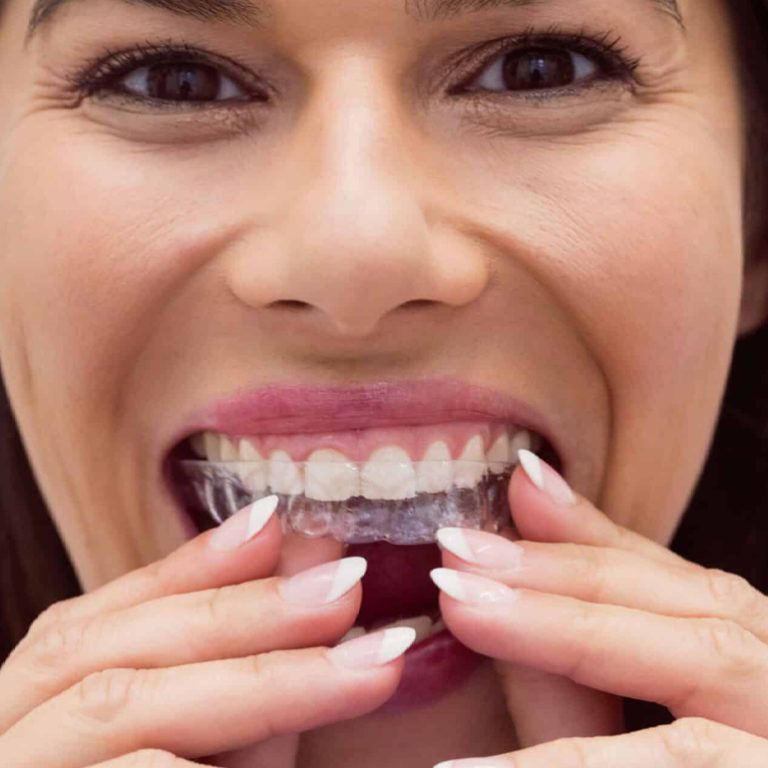 Teeth-straightening